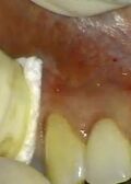 Single Tooth Replacement With Immediate Temporization In The Aesthetic Zone